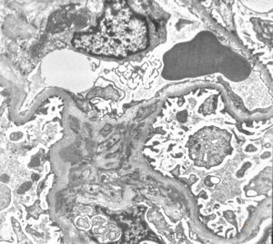 M,21y. | IgA nephropathy (Berger disease) M,21y. | IgA nephropathy (Berger disease)
